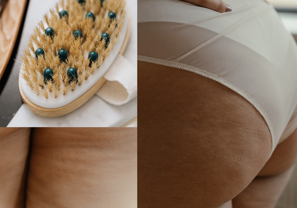 Cellulite loswerden: Was hilft gegen die lästige Orangenhaut?
