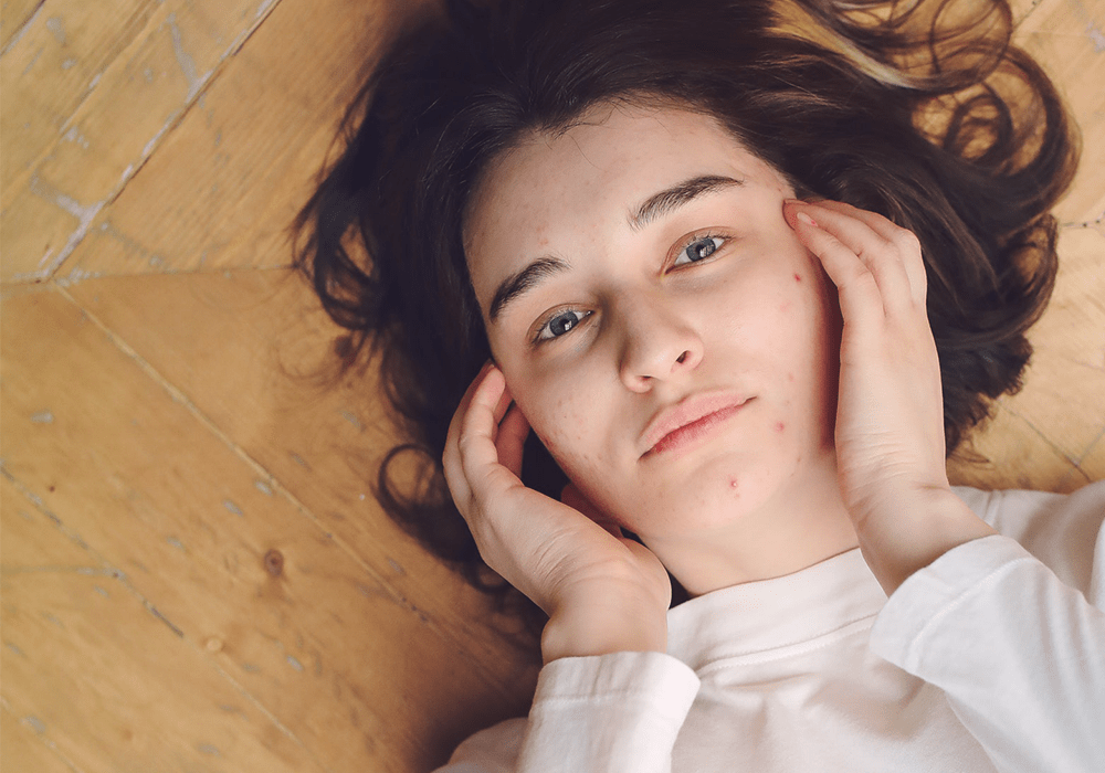 Aloe Vera gegen Pickel