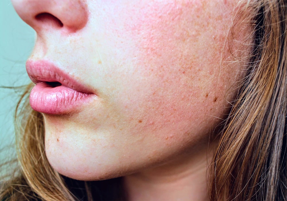 Rosacea - Ursachen, Symptome und Behandlung