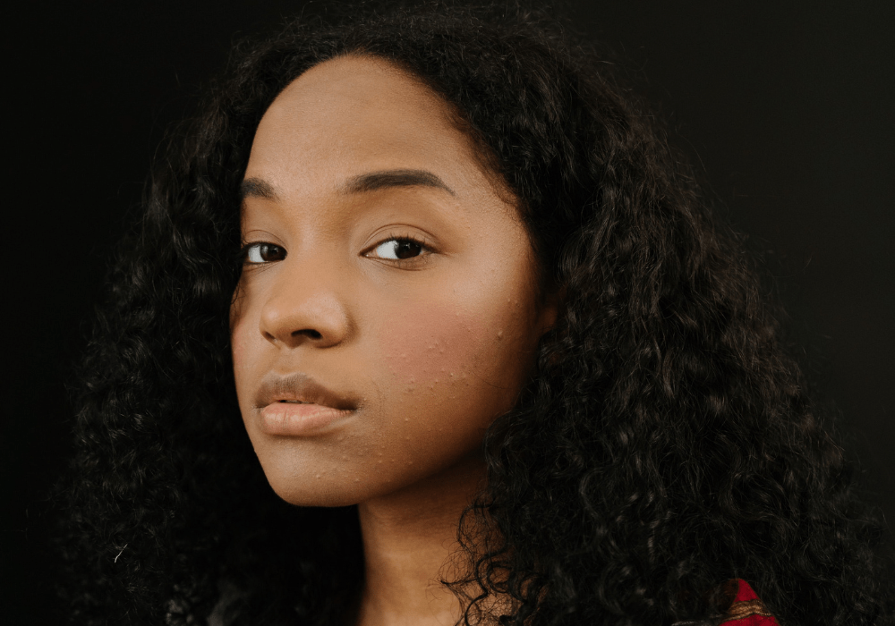 Unreine Haut mit 30: 15 Tipps für ein schöneres Hautbild