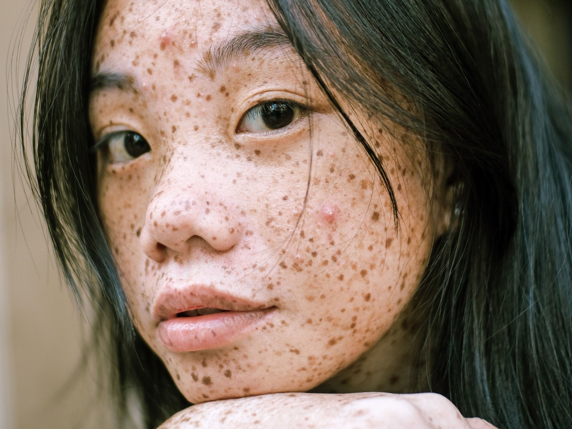 Face Mapping: Die Ursachen für Pickel im Gesicht